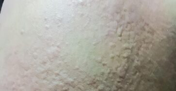 Hives and Breathing Changes: Warning Signs You Should Never Ignore