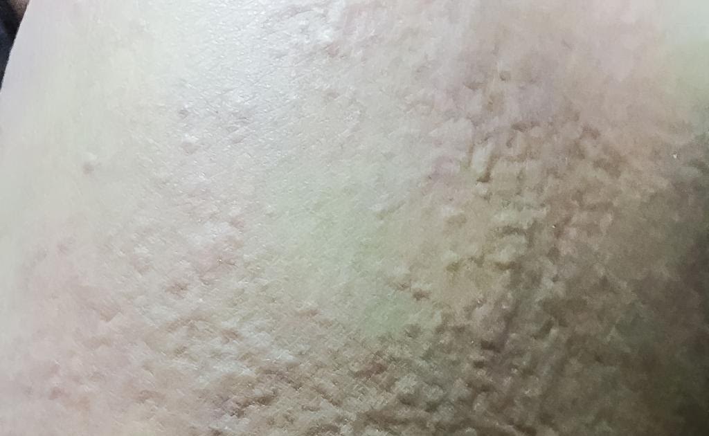 Hives and Breathing Changes: Warning Signs You Should Never Ignore